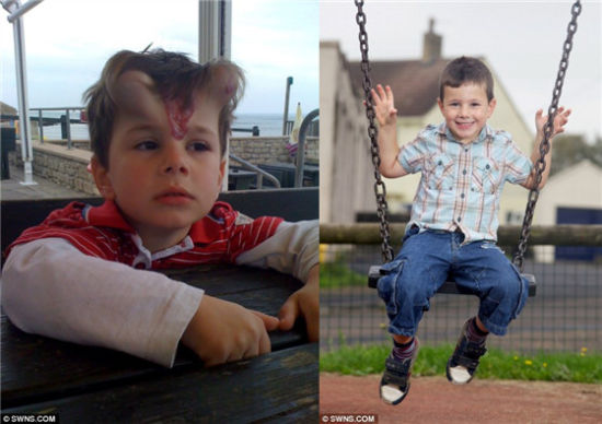英国5岁男孩乔治·阿斯曼为了祛除脑门上的红色胎记，被植入两个扩展器以取得长出的皮肤覆盖在额头上。现在乔治已经恢复健康。