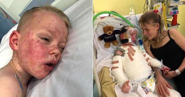 英国5岁男孩得罕见怪病，全身似“被泼硫酸”，长满水泡严重烧伤