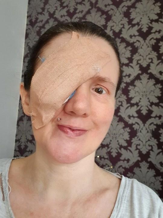英国女用毛巾擦伤眼角膜致穿孔，右眼球大部分被摘除，工作也辞了