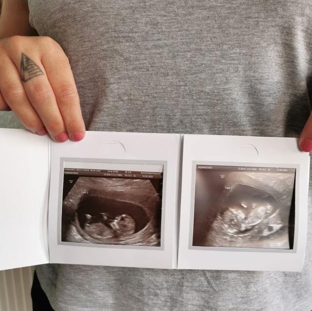 英国孕妇做产检又惊又喜：怀上双胞胎，但却怀在两个子宫里