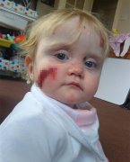 英5岁“蝴蝶女孩”患罕见疾病，出生起皮肤一碰